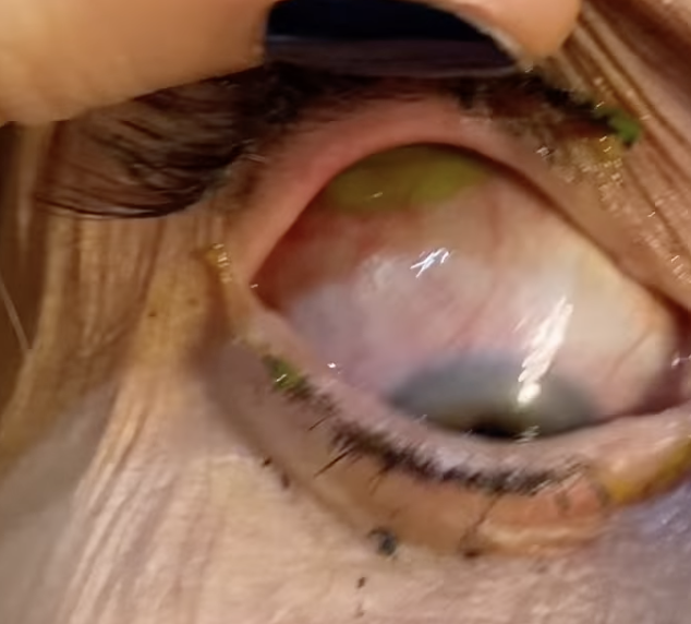 Augenärztin entfernt Kontaktlinse unter Augenlid von Patientin