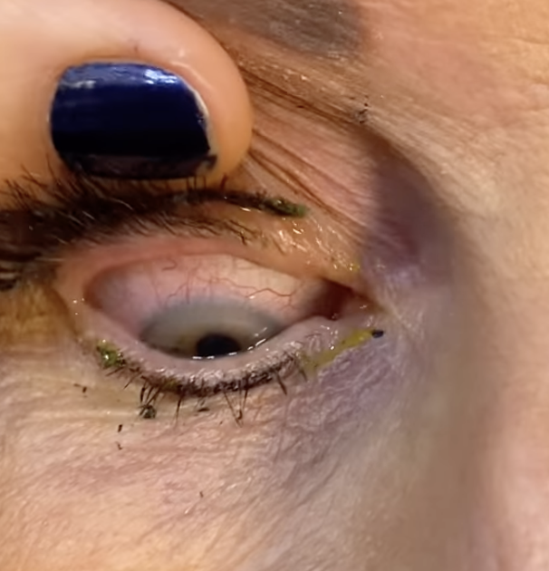 Augenärztin hebt Augenlid von Patientin